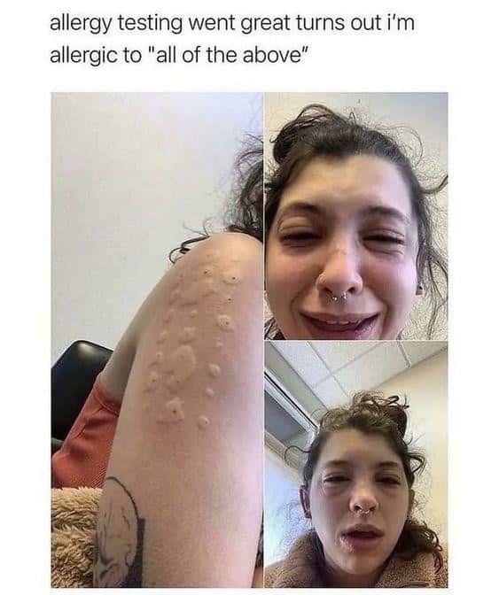 Skin Meme: Woman shows skin hives after allergy test